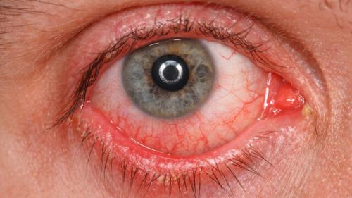 هشدارهای یک چشم پزشک در رابطه با استفاده از لنزهای زیبایی و کاشت مژه