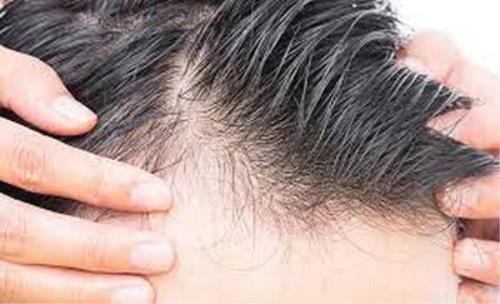 همه چیز درباره ی مبتلاشدن و انتقال شپش