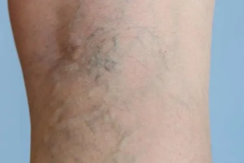 با چند عادت ساده از مبتلا شدن به واریس پیشگیری نماییم