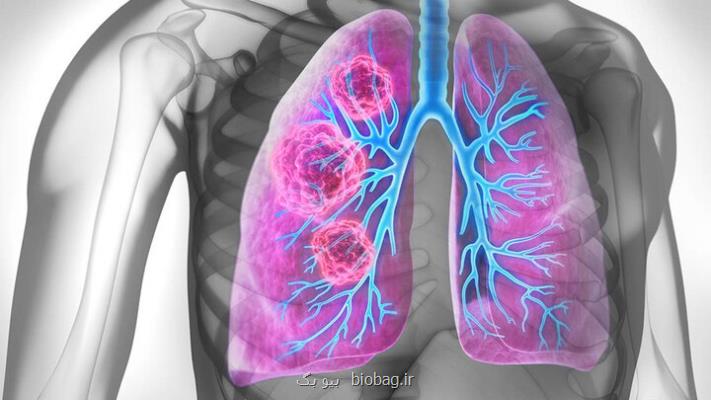 از هر ۵ بیمار دچار سرطان ریه، یک نفر غیرسیگاری است