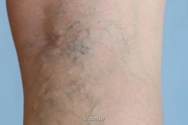 با چند عادت ساده از مبتلا شدن به واریس پیشگیری نماییم