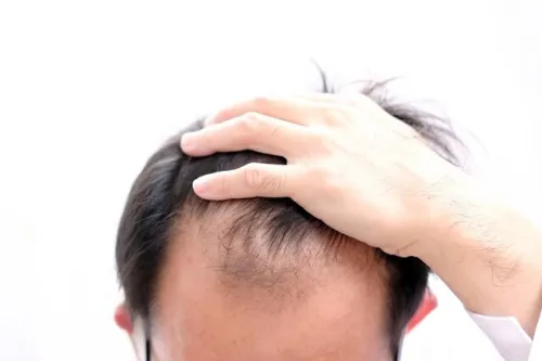 علل شایع ریزش مو