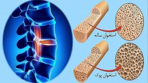 استعمال دخانیات و مصرف کورتون سبب افزیش احتمال مبتلاشدن به پوکی استخوان می شود