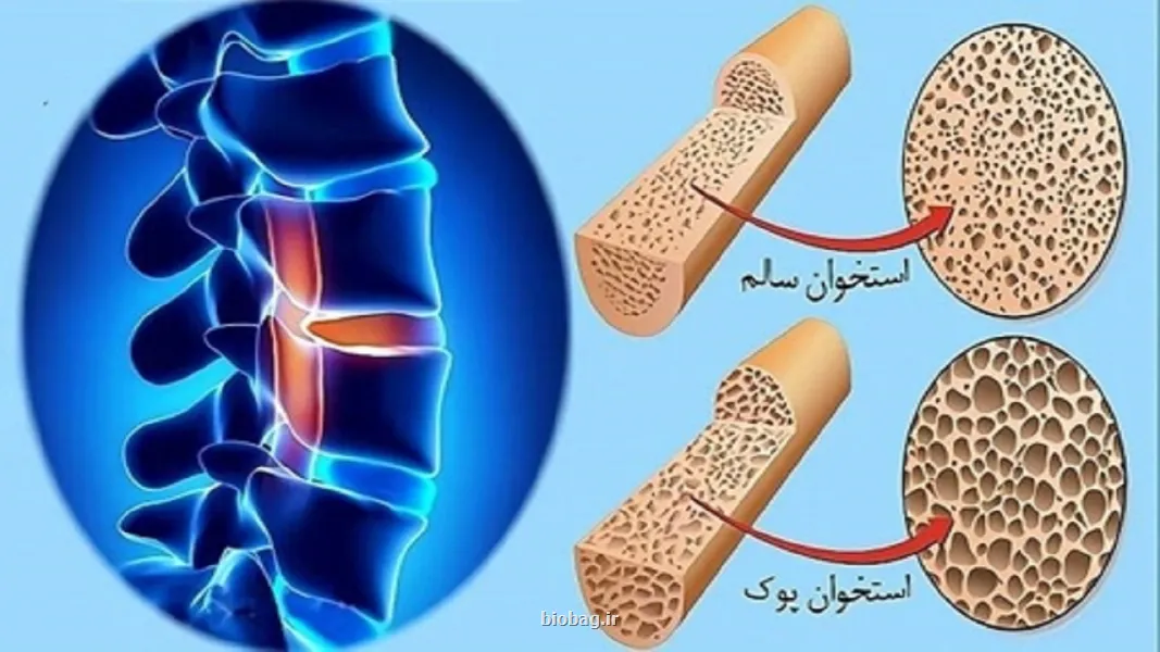 استعمال دخانیات و مصرف کورتون سبب افزیش احتمال مبتلاشدن به پوکی استخوان می شود