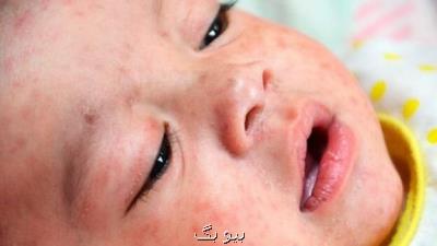 افزایش ۳ برابری مبتلایان به سرخك در جهان