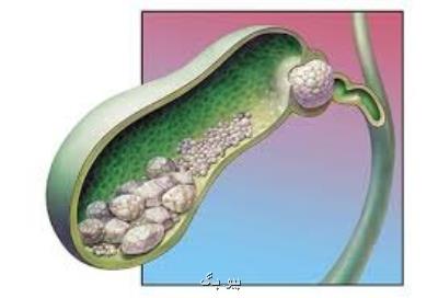نوشیدنی كه از سنگ كیسه صفرا پیشگیری می كند