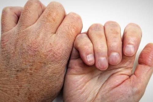 95 درصد مردم هیچگاه جذام نمی گیرند